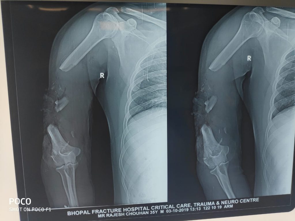 X-ray of a man who suffered a horrific crush injury to his - MEDizzy