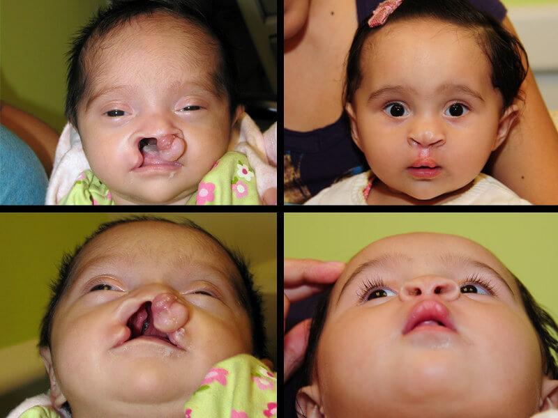 Cleft Surgery