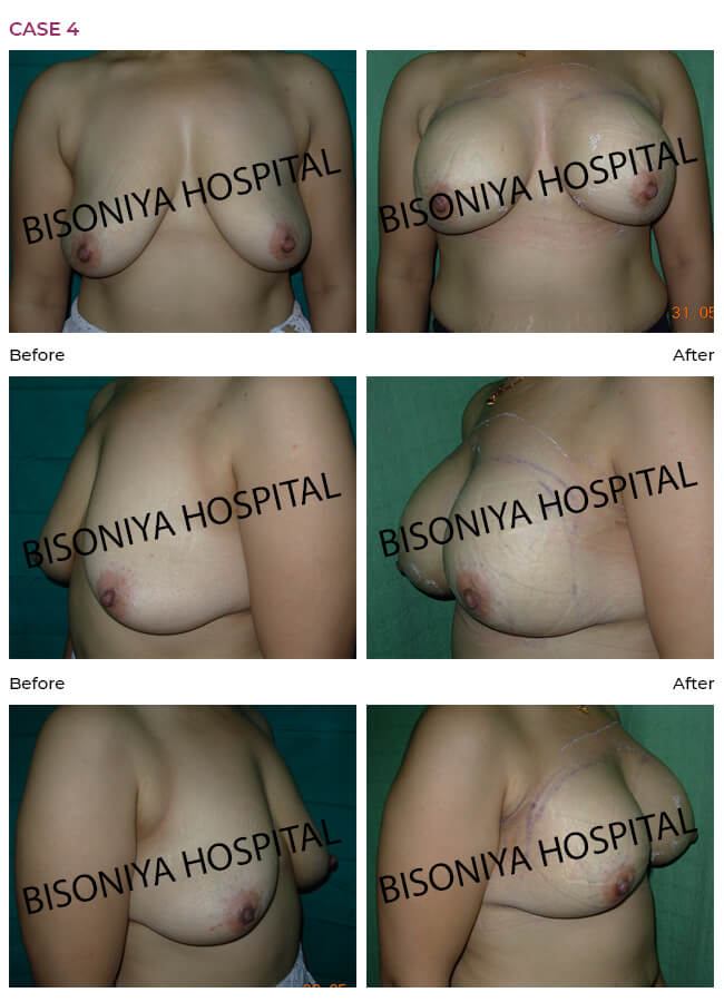 Breast Enlargement case4