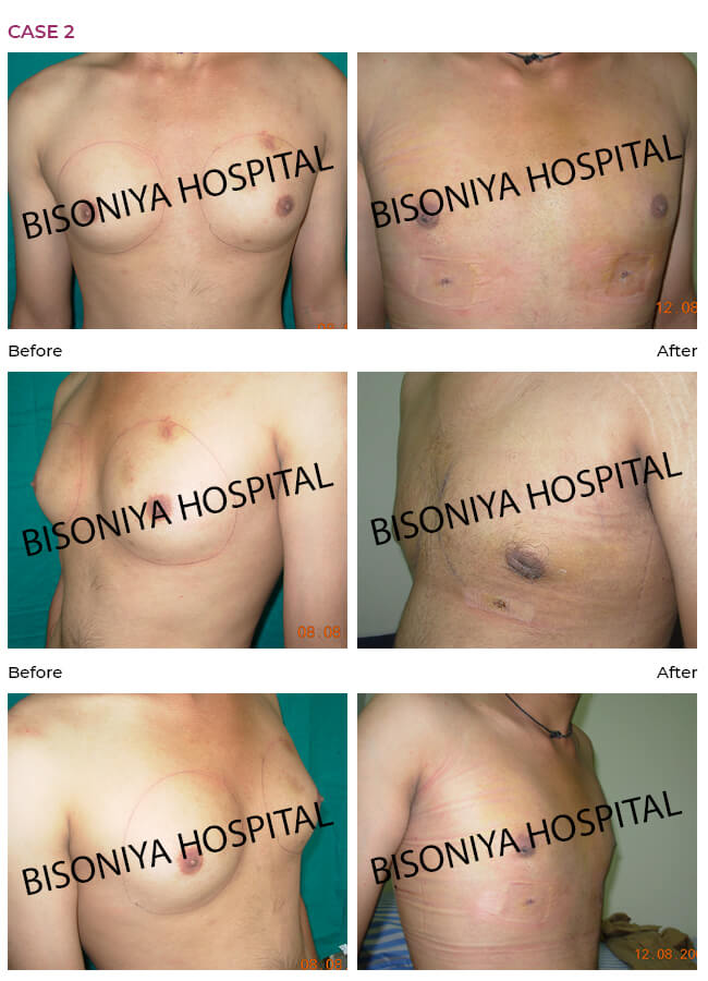 Gynecomastia - Bisoniya Hospital