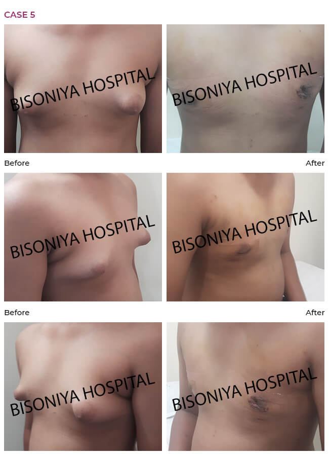 Gynecomastia - Bisoniya Hospital