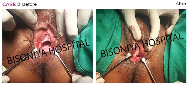 Hymenoplasty - Bisoniya Hospital