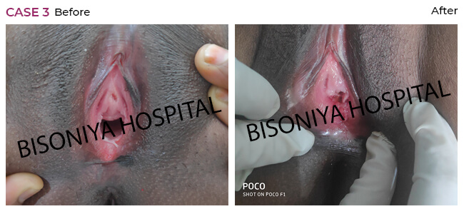 Hymenoplasty - Bisoniya Hospital
