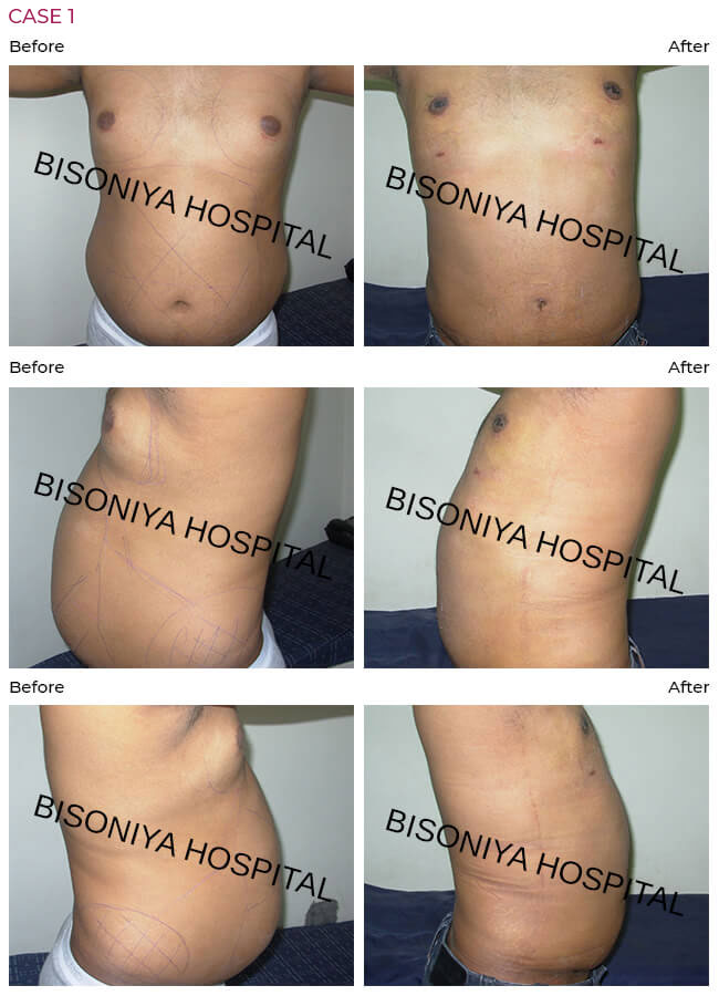 Liposuction - Bisoniya Hospital