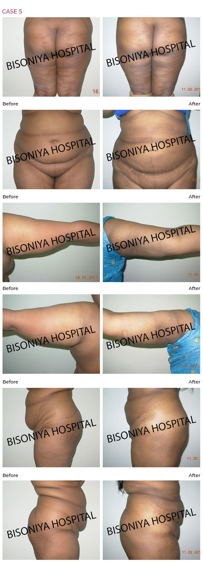 Liposuction - Bisoniya Hospital