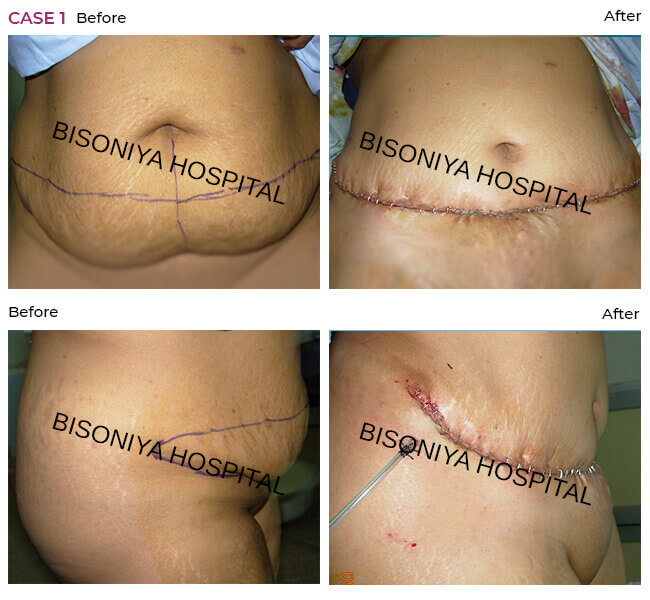 Abdominoplasty - Bisoniya Hospital
