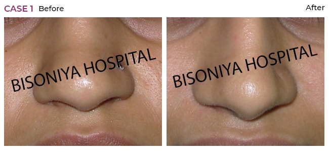 Rhinoplasty - Bisoniya Hospital