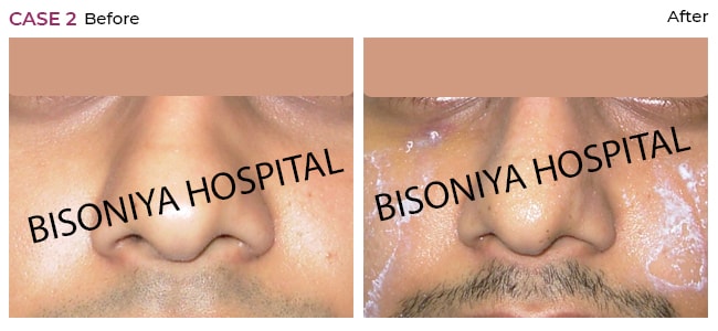 Rhinoplasty - Bisoniya Hospital