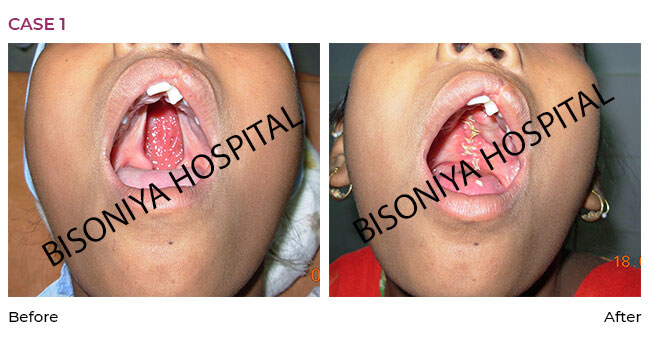 Cleft Palate Surgery - Case1