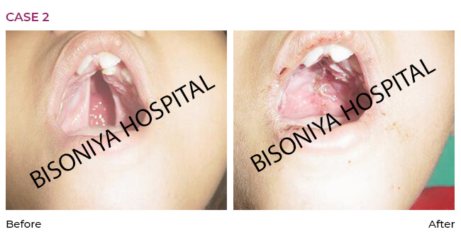 Cleft Palate Surgery - Case2